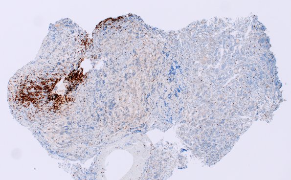 4B2 Lymphocytic Hypophysitis (Case 4) CD3 4X 2