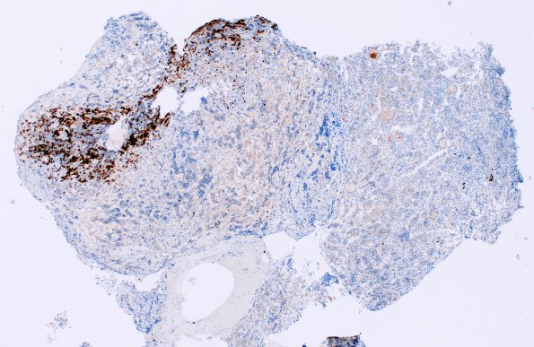 4C1 Lymphocytic Hypophysitis (Case 4) CD 20 4X 2