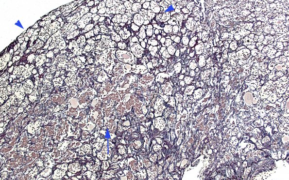 4D1 Lymphocytic Hypophysitis (Case 4) Retic 2 copy