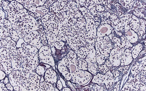 4D2 Lymphocytic Hypophysitis (Case 4) Retic 1