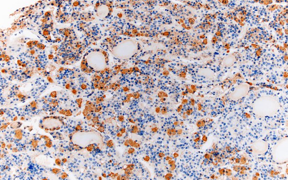 4E1 Lymphocytic Hypophysitis (Case 4) ACTH 2