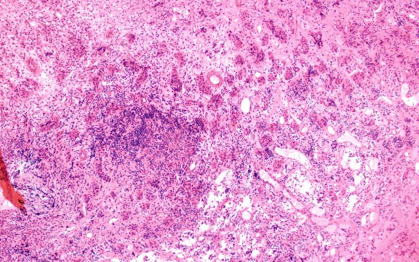 5A1 Lymphocytic Hypophysitis (Case 5) H&E 7