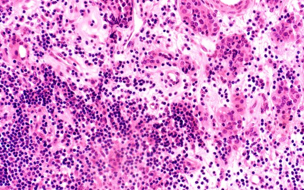 5A2 Lymphocytic Hypophysitis (Case 5) H&E 1