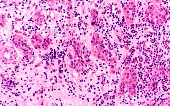 5A3 Lymphocytic Hypophysitis (Case 5) H&E 4