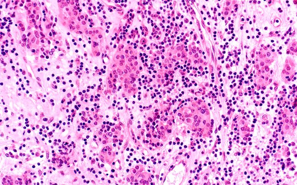 5A4 Lymphocytic Hypophysitis (Case 5) H&E 5