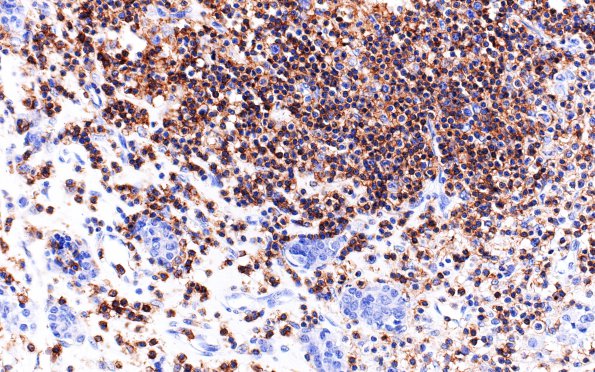 5B3 Lymphocytic Hypophysitis (Case 5) LCA 2