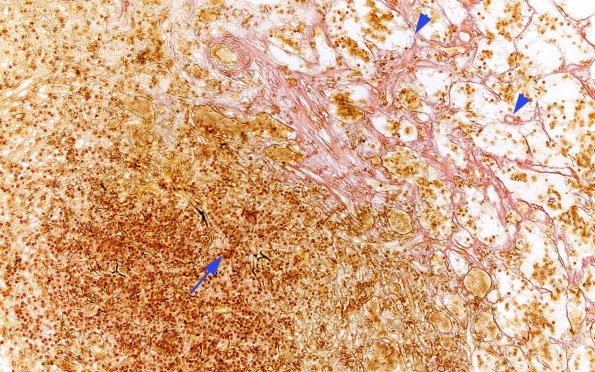 5C1 Lymphocytic Hypophysitis (Case 5) Retic 2 copy