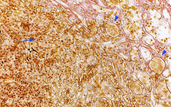 5C2 Lymphocytic Hypophysitis (Case 5) Retic 3 copy