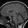 1A1 Hypophysitis, Xanthomatous, ruptured RCleftC (Case 1) T1 2 - Copy