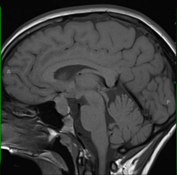 1A1 Hypophysitis, Xanthomatous, ruptured RCleftC (Case 1) T1 2 - Copy