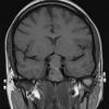 1A2 Hypophysitis, Xanthomatous, ruptured RCleftC (Case 1) T1 - Copy