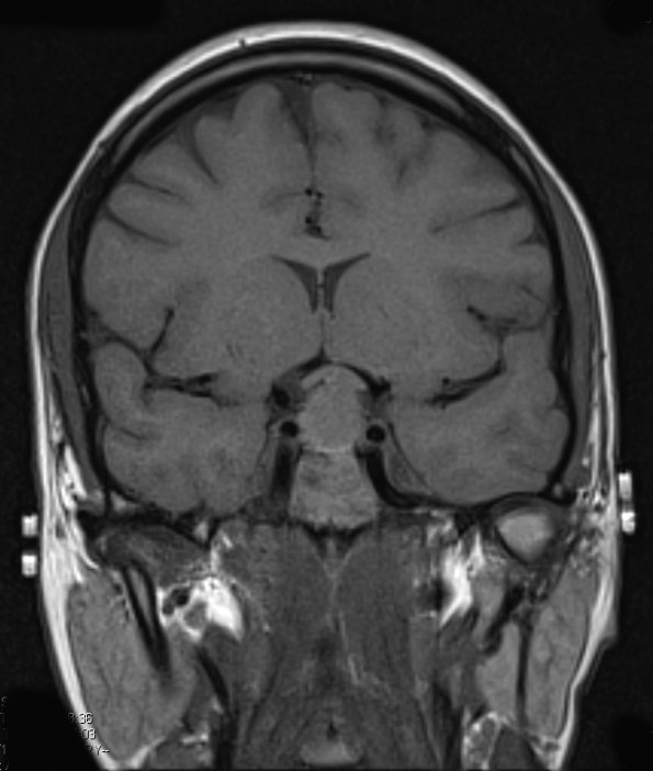 1A2 Hypophysitis, Xanthomatous, ruptured RCleftC (Case 1) T1 - Copy