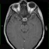 1A3 Hypophysitis, Xanthomatous, ruptured RCleftC (Case 1) T1 W 1 - Copy