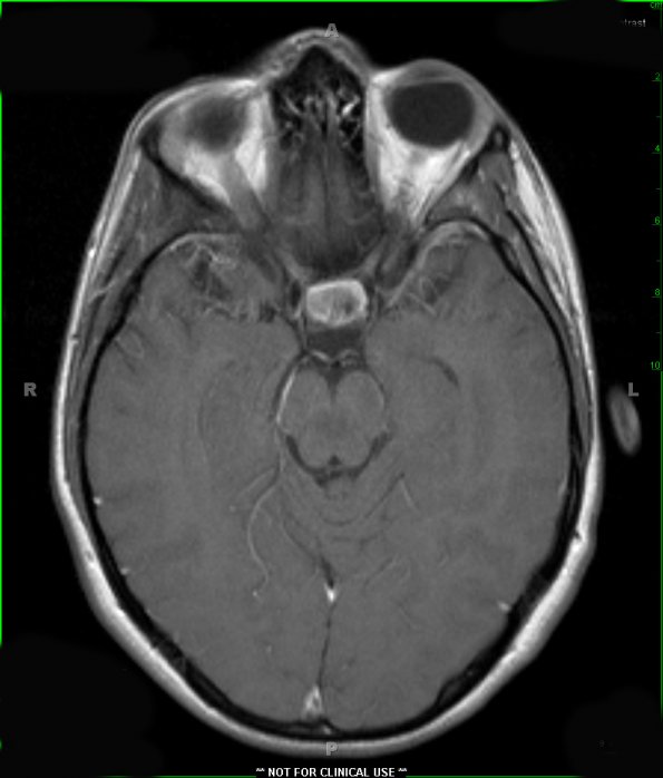 1A3 Hypophysitis, Xanthomatous, ruptured RCleftC (Case 1) T1 W 1 - Copy