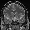 1A4 Hypophysitis, Xanthomatous, ruptured RCleftC (Case 1) T2 HIRES W - Copy