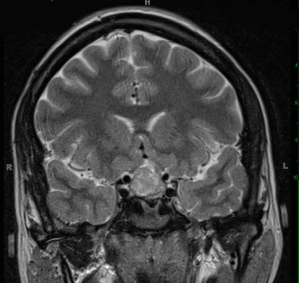 1A4 Hypophysitis, Xanthomatous, ruptured RCleftC (Case 1) T2 HIRES W - Copy