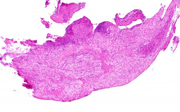 1B1 Hypophysitis, Xanthomatous, ruptured RCleftC (Case 1) H&E 3