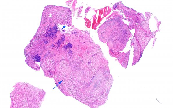 1B2 Hypophysitis, Xanthomatous, ruptured RCleftC (Case 1) H&E 10 copy