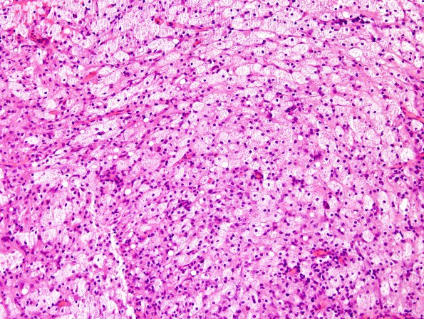 1B3 Hypophysitis, Xanthomatous, ruptured RCleftC (Case 1) H&E 14