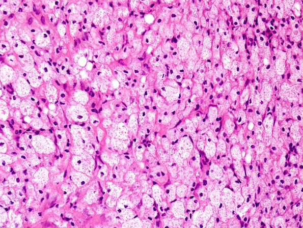 1B4 Hypophysitis, Xanthomatous, ruptured RCleftC (Case 1) H&E 15