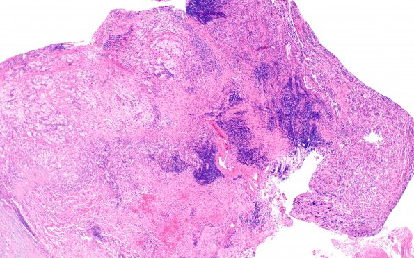 1B5 Hypophysitis, Xanthomatous, ruptured RCleftC (Case 1) H&E 18