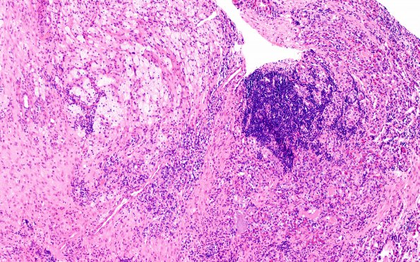 1B6 Hypophysitis, Xanthomatous, ruptured RCleftC (Case 1) H&E 19