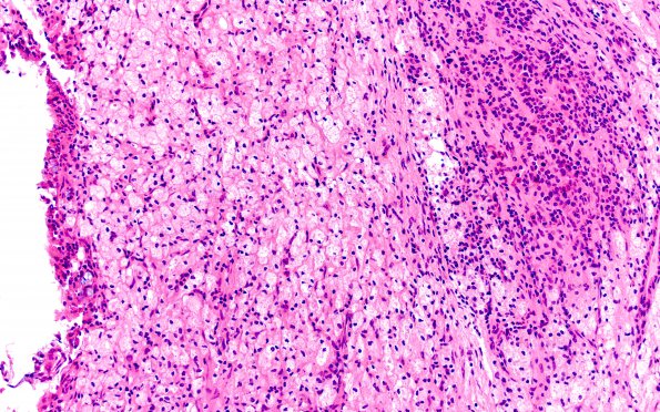 1B7 Hypophysitis, Xanthomatous, ruptured RCleftC (Case 1) H&E 5