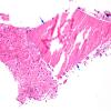 1D1 Hypophysitis, Xanthomatous, ruptured RCleftC (Case 1) H&E 3 copy