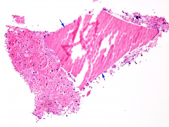 1D1 Hypophysitis, Xanthomatous, ruptured RCleftC (Case 1) H&E 3 copy