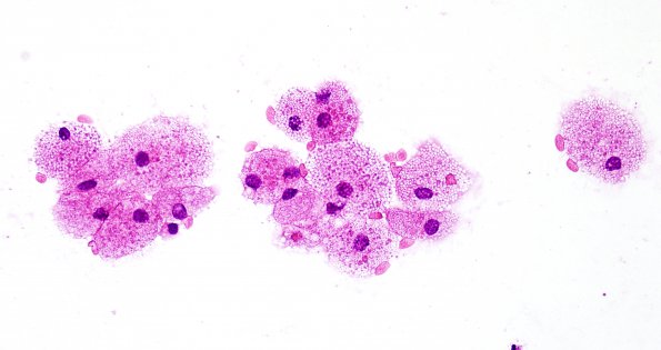 1D2 Hypophysitis, Xanthomatous, ruptured RCleftC (Case 1) H&E 1A