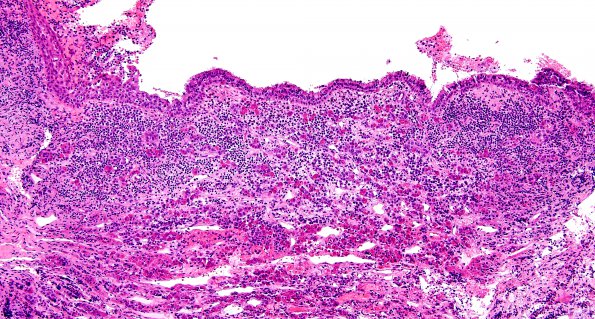 1D3 Hypophysitis, Xanthomatous, ruptured RCleftC (Case 1) H&E 10X