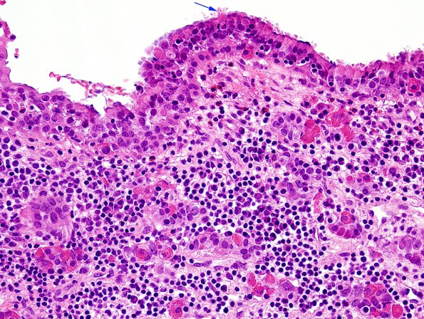 1D4 Hypophysitis, Xanthomatous, ruptured RCleftC (Case 1) H&E 23 copy