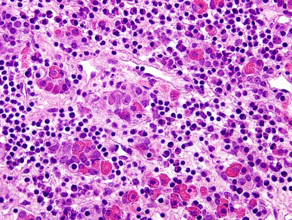 1D6 Hypophysitis, Xanthomatous, ruptured RCleftC (Case 1) H&E 16