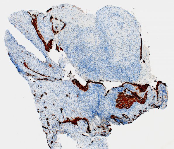 1E1 Hypophysitis, Xanthomatous, ruptured RCleftC (Case 1) CK 2