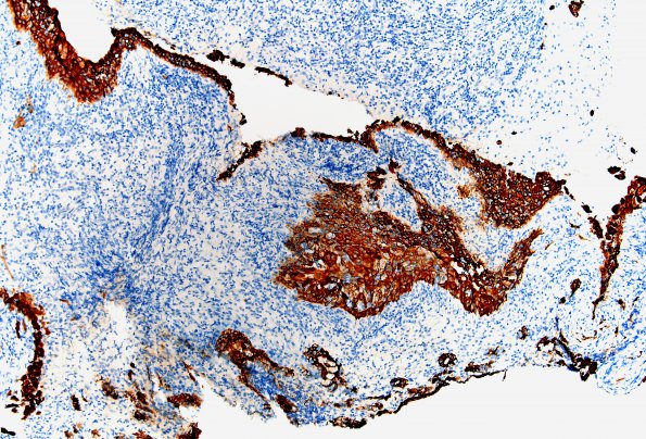 1E2 Hypophysitis, Xanthomatous, ruptured RCleftC (Case 1) CK 1