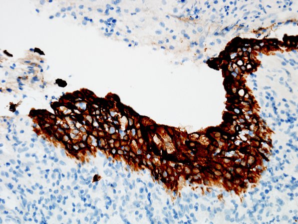 1E3 Hypophysitis, Xanthomatous, ruptured RCleftC (Case 1) CK 1