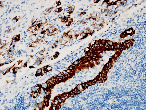 1E4 Hypophysitis, Xanthomatous, ruptured RCleftC (Case 1) CK 2