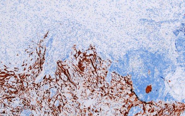 1F2 Hypophysitis, Xanthomatous, ruptured RCleftC (Case 1) GFAP 2