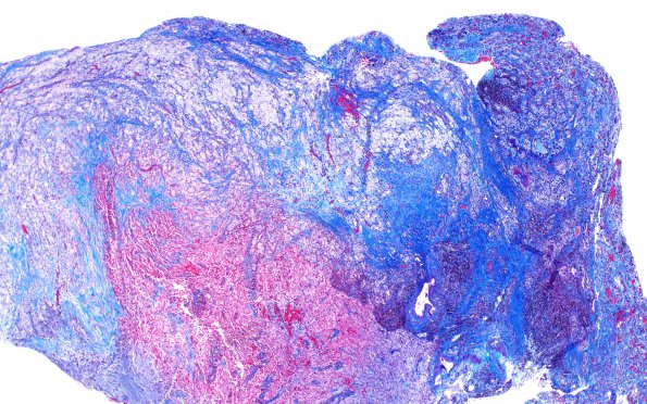 1G1 Hypophysitis, Xanthomatous, ruptured RCleftC (Case 1) Trichrome 2