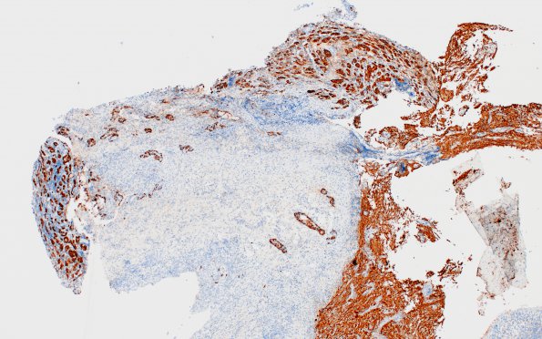 1H1 Hypophysitis, Xanthomatous, ruptured RCleftC (Case 1) Synaptophysin 1