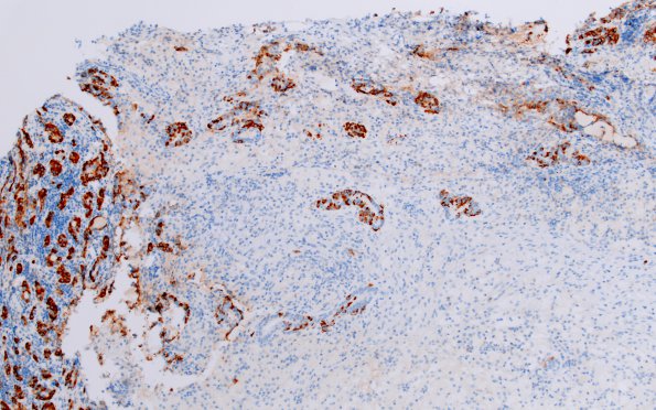 1H2 Hypophysitis, Xanthomatous, ruptured RCleftC (Case 1) Synaptophysin 5