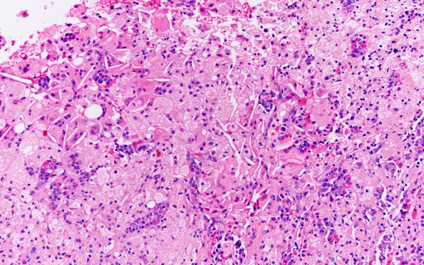 2A2 Hypophysitis, xanthomatous (Case 2) H&E 7