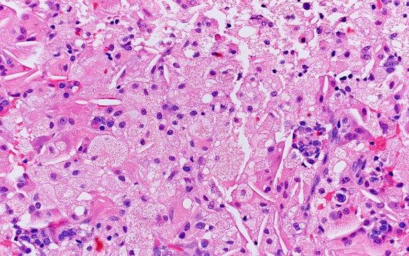 2A3 Hypophysitis, xanthomatous (Case 2) H&E 2