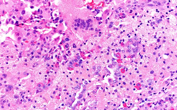 2A4 Hypophysitis, xanthomatous (Case 2) H&E 1