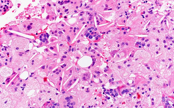 2A5 Hypophysitis, xanthomatous (Case 2) H&E 3