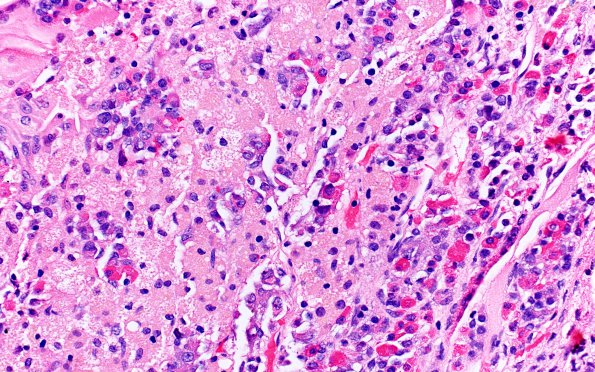 2A6 Hypophysitis, xanthomatous (Case 2) H&E 9