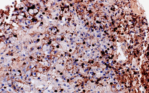 2B Hypophysitis, xanthomatous (Case 2) LCA 1