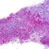 2C1 Hypophysitis, Granulomatous-xanthomatous (Case 2) PAS 2