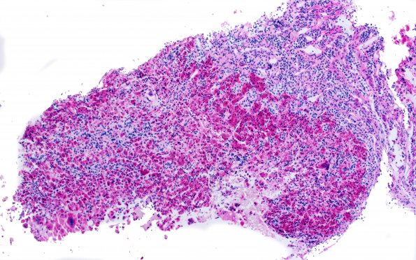 2C1 Hypophysitis, Granulomatous-xanthomatous (Case 2) PAS 2