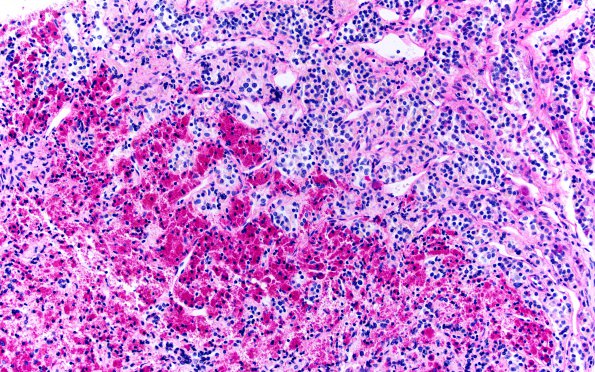 2C2 Hypophysitis, xanthomatous (Case 2) PAS 1